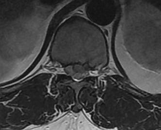 Thoracic Herniate Disc Axial